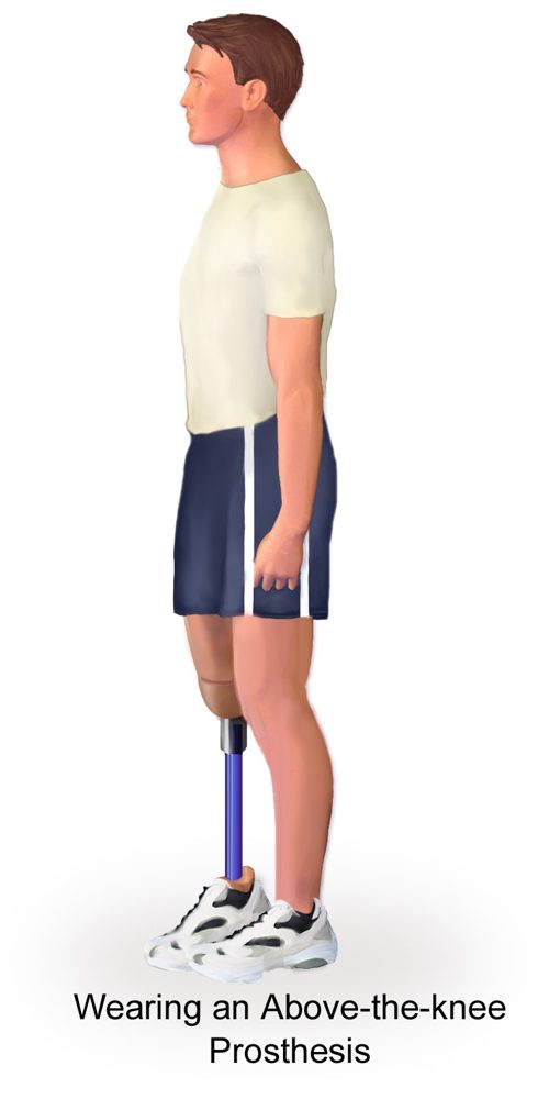 Illustration of a person standing side-on wearing an above-knee prosthesis